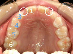 子どもの矯正治療（1期治療）を行わない場合03