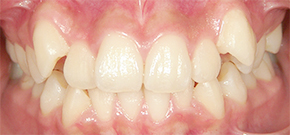 八重歯の治療(Before)