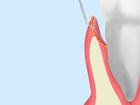 歯周ポケットそうは術