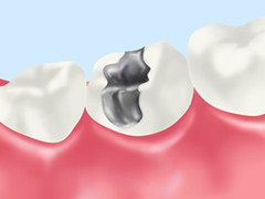 銀歯とセラミックの違い