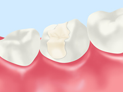銀歯とセラミックの違い